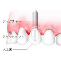 インプラント治療とは