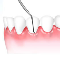 歯周病とは歯周病菌による感染症