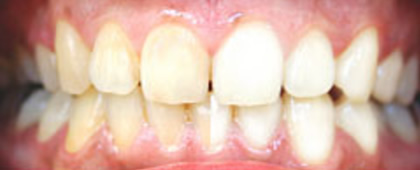 BeforeAfter